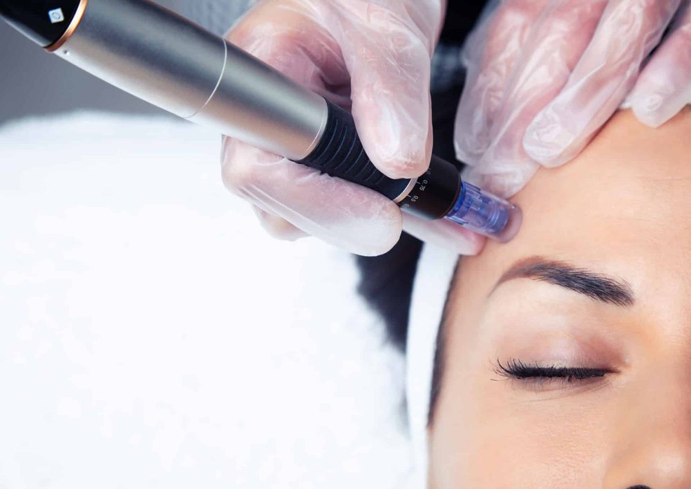 Dermapen microneedling-behandling