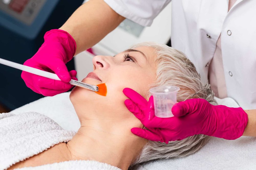 Kjemisk peeling-behandling