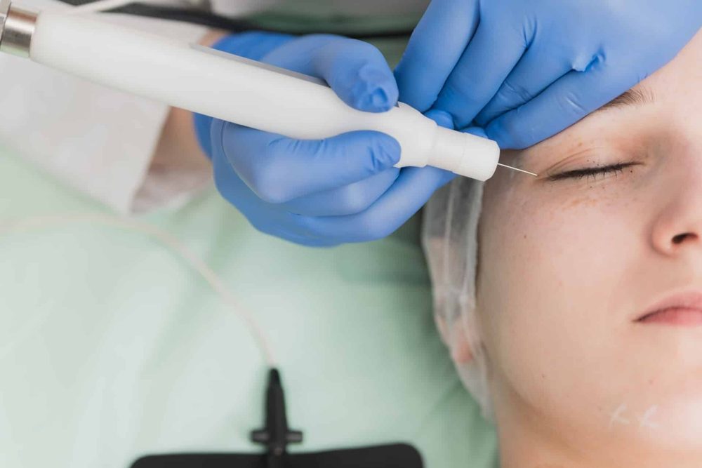 Plexr plasmapen-behandling