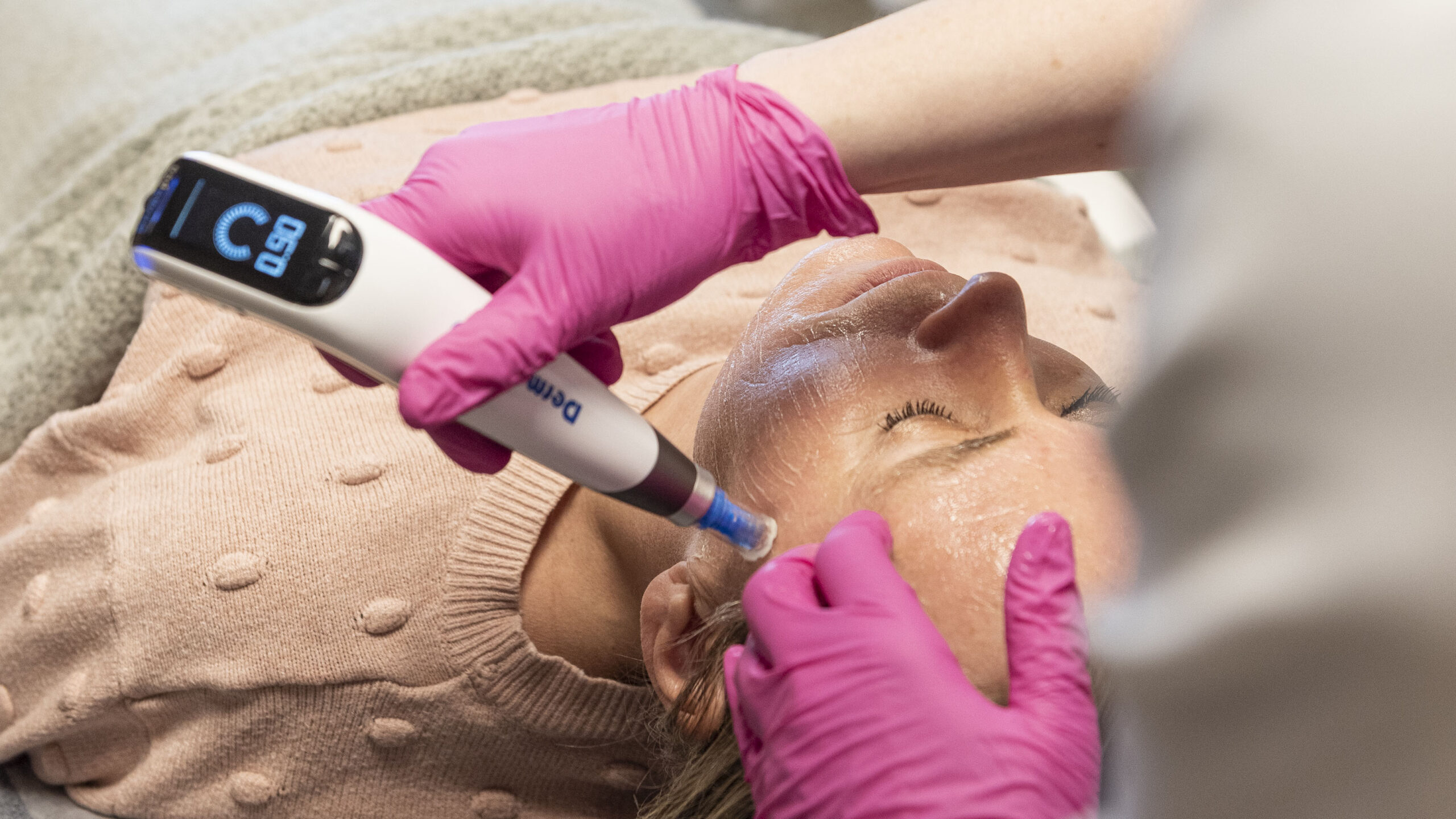 Microneedling-behandling