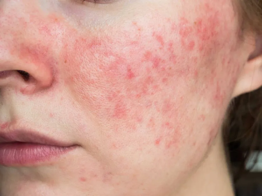 Nærbilde av hud med rosacea og rødhet