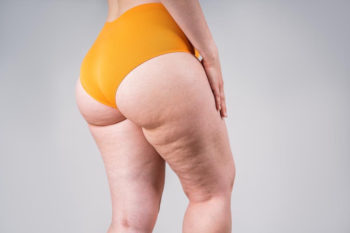 Lipedema