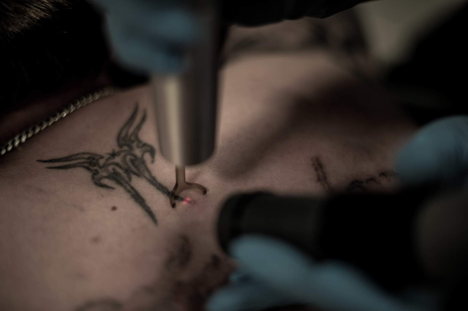 Tattoo removal