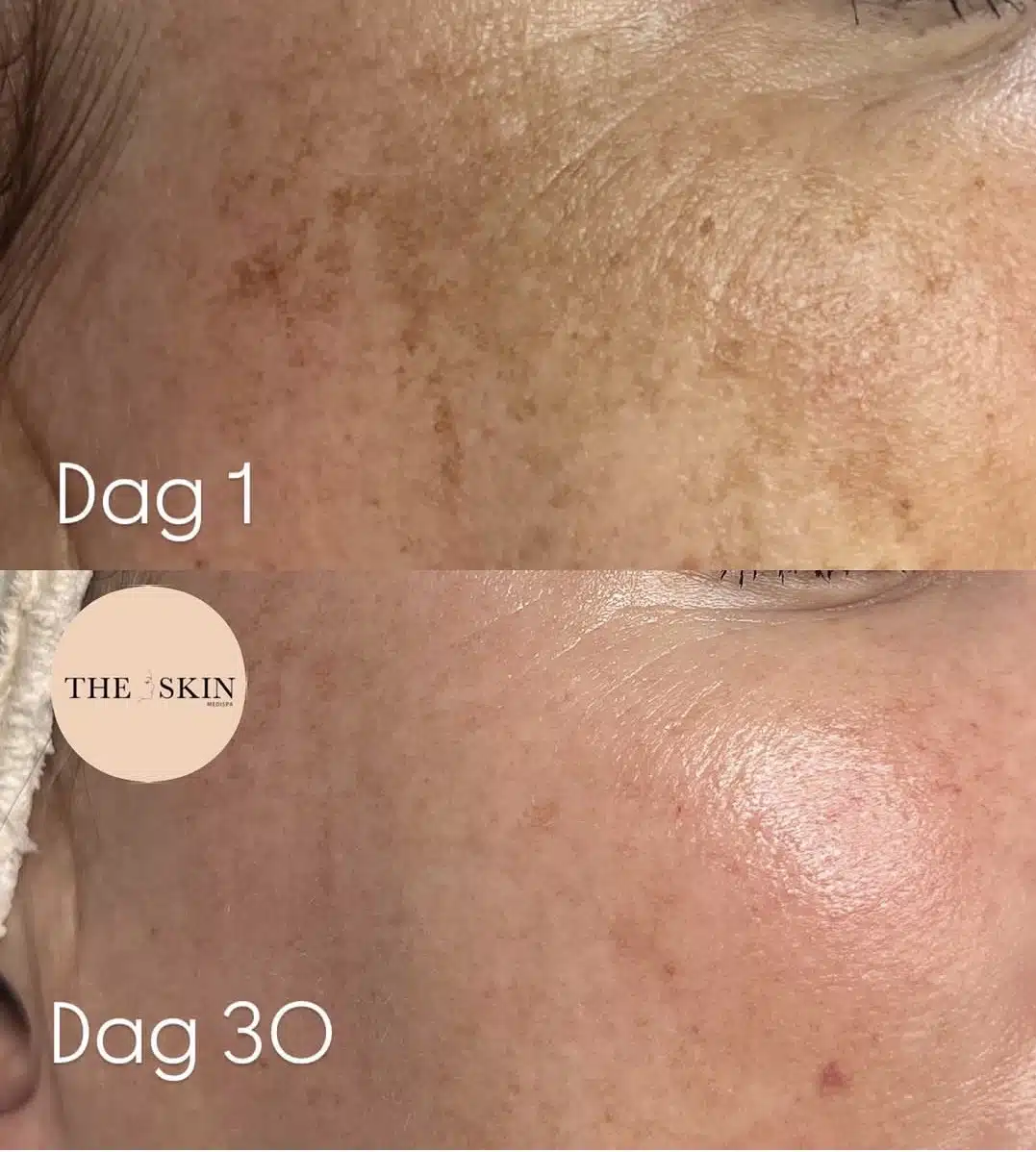 Før og etter behandling hos The Skin Medispa — dag 1 og dag 30